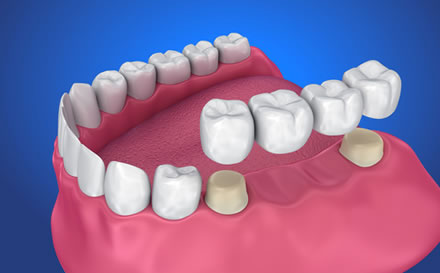 Dental Bridges - General Dentistry Colorado