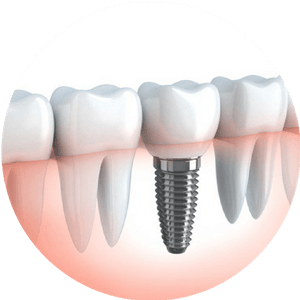 Dental Implants Denver - Dentistry of Colorado