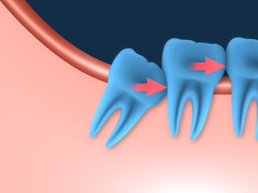 Wisdom Teeth Removal Denver Area