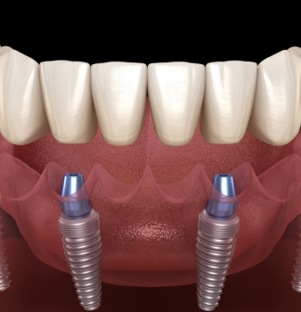 The All-on-4 Dental Implant Journey: A Comprehensive Guide